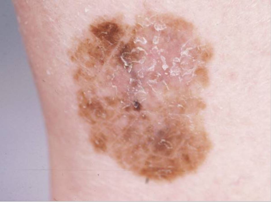 ИЈЗ: Меланом – најопасен облик на рак на кожа, може да се излечи ако се открие навреме